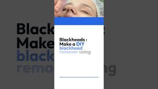 How to Get Rid of Blackheads Naturally : Home Remedies