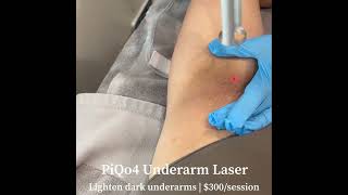 Full legs scars treatment#skincare#scars#facial#brightning#beauty