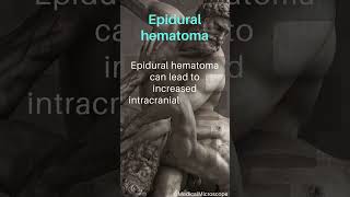 Epidural hematoma │ Selected medical terminology │ #medicalterminology #epiduralhematoma #short