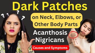 Dark Patches on your Neck, Elbows, or Other body parts | Acanthosis Nigricans Causes & Symptoms