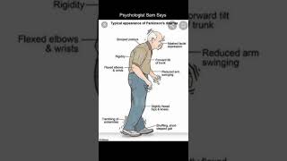 Psychologist Sam Says | Appearance of Parkinson's Disease