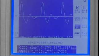 ABI With Doppler Pressures & Doppler Waveforms