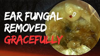 Ear Fungal Removed Gracefully