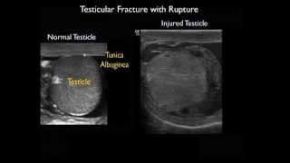 Bedside Ultrasound in a Case of Blunt Scrotal Trauma 1