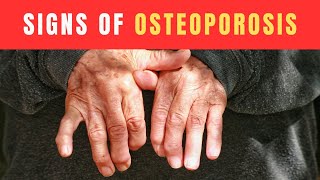 Signs or Symptoms of Osteoporosis and How You Can Prevent Bone Fracture #signsosteoporosis