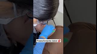 preenchimento Labial 💋 como é realizado a aplicação com cânula!