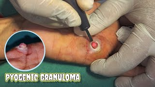 Removal of Granuloma from a hand by Laser