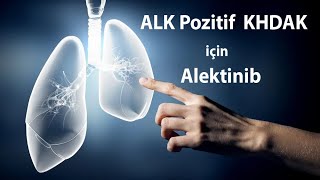 ALK pozitif Erken Evre Akciğer Kanserinde Alektinib FDA Onayı Aldı