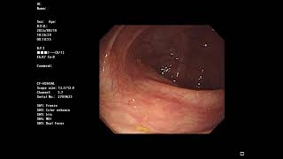 Ulcerative Colitis and small polyp, Asacol / OLYMPUS 290 + CF-H260AL  .NINJA V+ Recording 2024-08-19