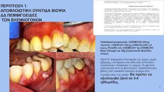 ΤΟΠΙΚΗ ΘΕΡΑΠΕΙΑ ΟΜΑΛΟΥ ΛΕΙΧΗΝΑ ΣΤΟΜΑΤΟΣ ΜΕ ΓΑΛΗΝΙΚΑ ΣΚΕΥΑΣΜΑΤΑ  1