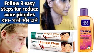 3 steps acne pimple दाग-धब्बे,दाने के लिए|best home remedy,facewash & cream| lifestyle with beauty24