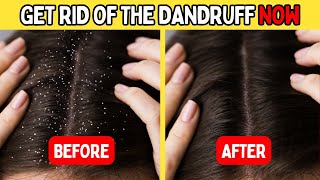 🔴[REVEALED]🔴: 6 Incredible Tips on How to Get Rid of Dandruff! #dandruff #dandrufffreehair