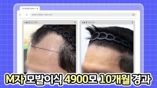 [Mobien TV] 30대 남성 M자 모발이식 절개 4900모 10개월 경과 #광주탈모치료 #전남모발이식