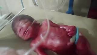 New born baby delivered with iscs baby is so cute baby with great care all the vernix removed