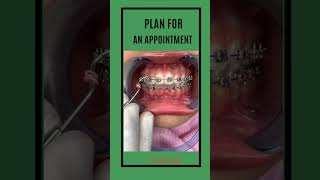 TEETH ALIGNMENT WITH BRACES