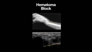 Ultrasound Guidance In Hematoma Block