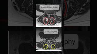 How to check Multifidus muscle in MRI ?