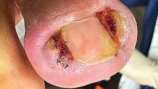 Extreme Double Ingrown Toenail Removal | Satisfying Transformation!