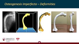 2 Update on Limb reconstruction and deformity correction in metabolic bone disorders   new implants,