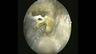 Temporal bone dissection part-4(2 handed endoscopic) opening IAM-dr.shreekantha acharya