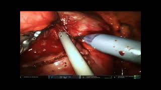 Robot Assisted Partial Nephrectomy in a Horseshoe Kidney