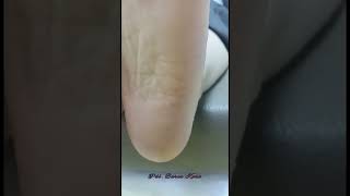 Callus Treatment | Topuk Çatlağı Bakımı