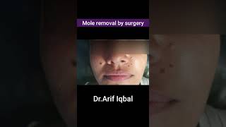 Mole removal surgery by Dr.Arif Iqbal