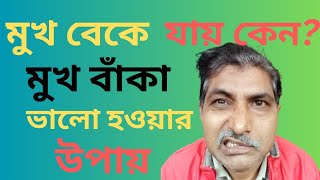 মুখ বাঁকা ভালো হওয়ার উপায়┃মুখ বাঁকা রোগের চিকিৎসা┃মুখ বাঁকা হলে করণীয় | Bell's Palsy Bangla