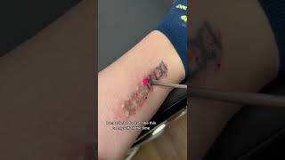 Laser tattoo removal process with Fotona Starwalker