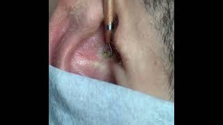 blackheads in ear