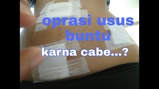 Oprasi usus buntu ditaiwan #cerita#tkw