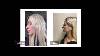 Beautiful Rhinoplasty Reveal by Dr. Guyuron