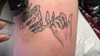 Black line tattoo on upper thigh of female laser tattoo removal