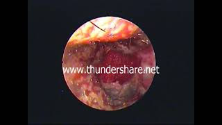 Endo tplasty replacement of posterior meatal skin  flap -dr.shreekantha acharya