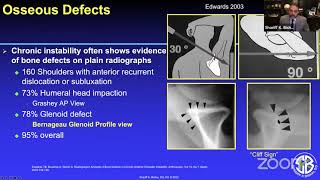 Glenoid Bone Loss and Treatment of Off-track Shoulder Instability