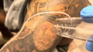 Removing face tattoo off upper arm