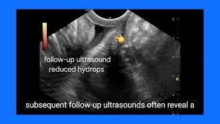 Understanding Cervical Hydrops: Ultrasound Findings, Follow-Up, Causes, and Treatment Explained