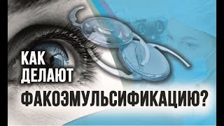 Как делают факоэмульсификацию катаракты? Что такое факоэмульсификация (ФЭК)?