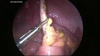 Very long Appendix Extending up to spleen   Laparoscopic Appendicectomy