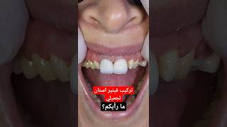 فينير اسنان تجميلي