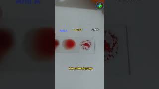 Blood grouping | ABO blood grouping | ABO system | Rh system | blood bank