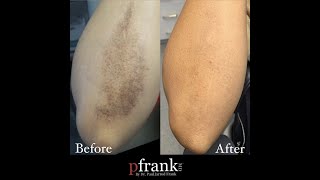 Treating this patient’s scar from an accident leaving her with post-inflammatory hyperpigmentation.