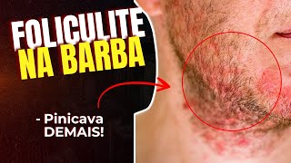 COMO TRATAR E PREVENIR A FOLICULITE NA BARBA [SAIBA AGORA]