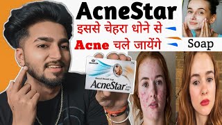 इससे चेहरा धोने से Acne चले जायेंगे | AcneStar Soap For Acne, Pimples | AcneStar Soap Review