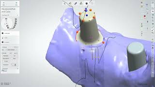 Abutment Design with 3shape 2022