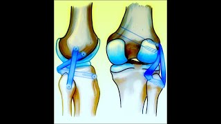 Posterolateral Corner Reconstruction ( LaPrade Vs Arciero)