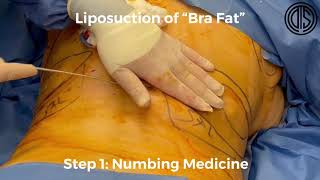 Liposuction of "Bra Fat"