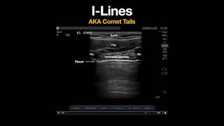 I -lines - AKA Comet Tails