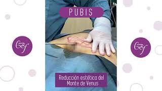 LIPOESCULTURA LÁSER: Pubis y sacro (Clínica Bellaforma)