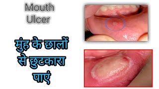 मुंह के छाले || Mouth Ulcer, मुंह के छालों को दूर करने का घरेलू उपाय अपनाएं हाथो हाथ रिजल्ट पाएं।